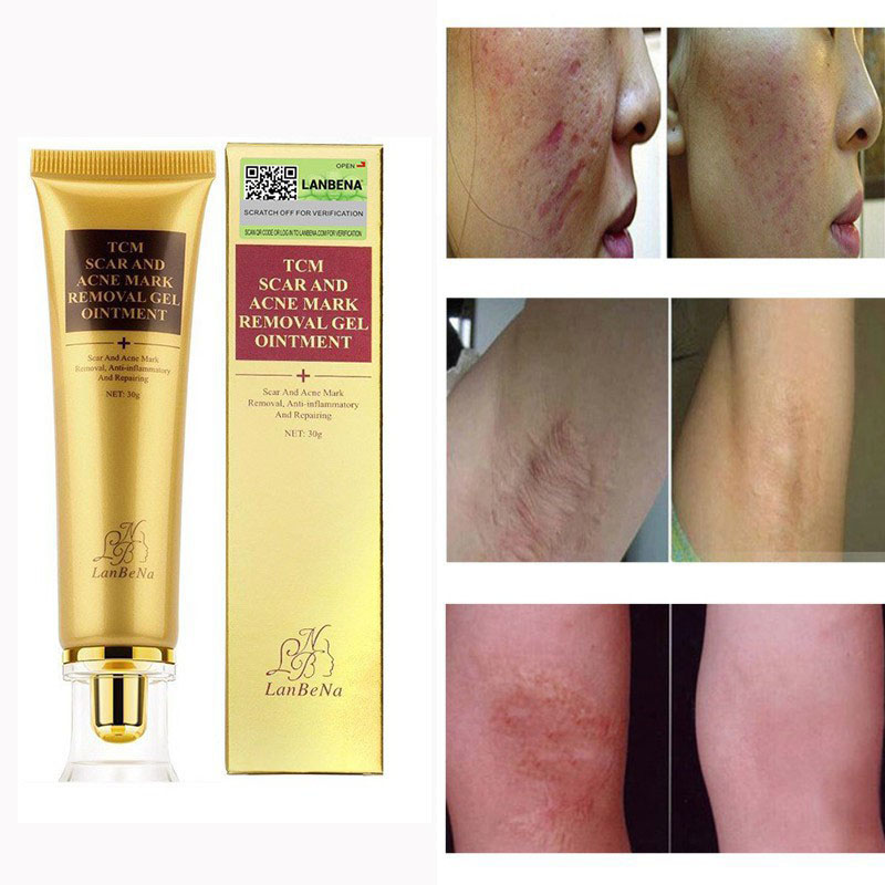 TCM scar and acne mark removal gel ointment - 30g